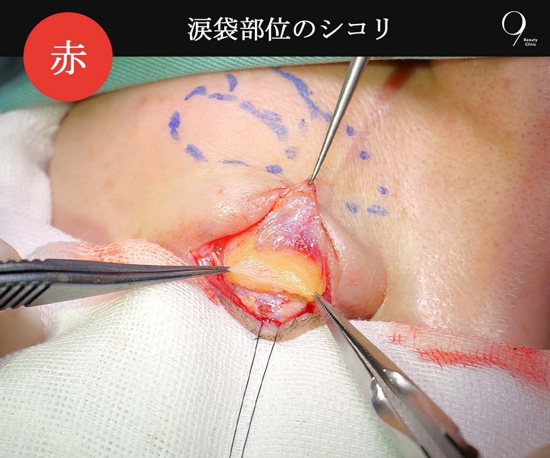 赤(涙袋部位)のシコリ