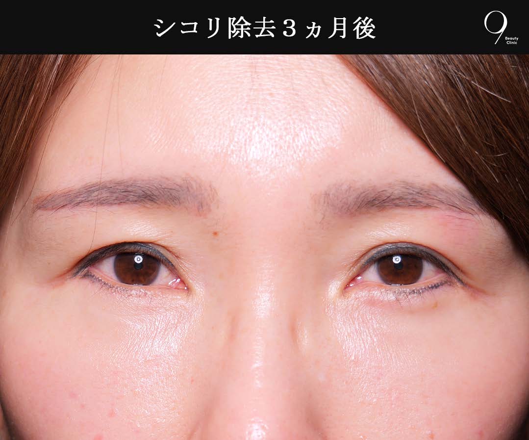 シコリ除去3ヶ月後