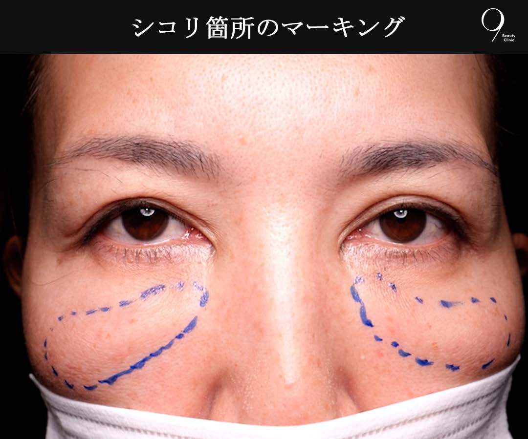 シコリ箇所のマーキング