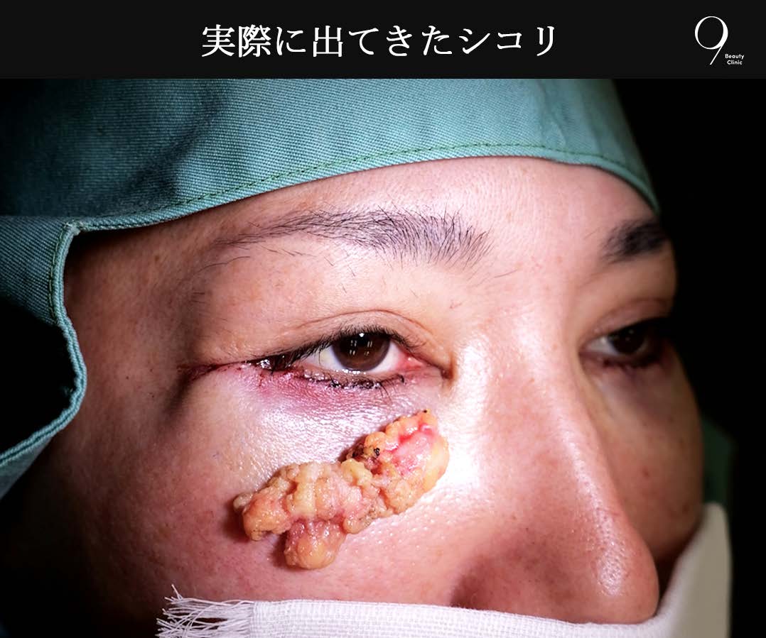 実際に出てきたシコリ