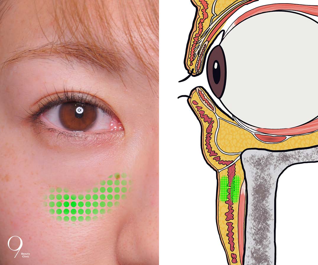 下方に大量に貯留