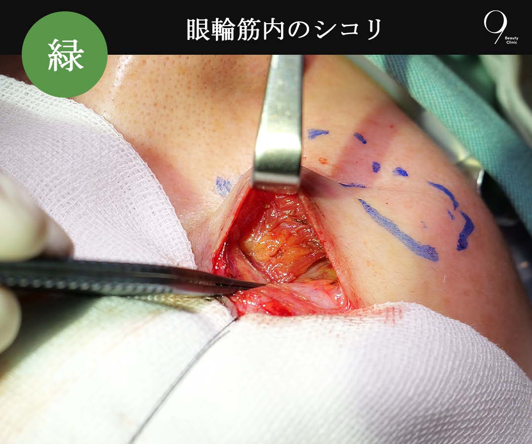 症例③:緑(ティアトラフ靱帯下)のシコリ