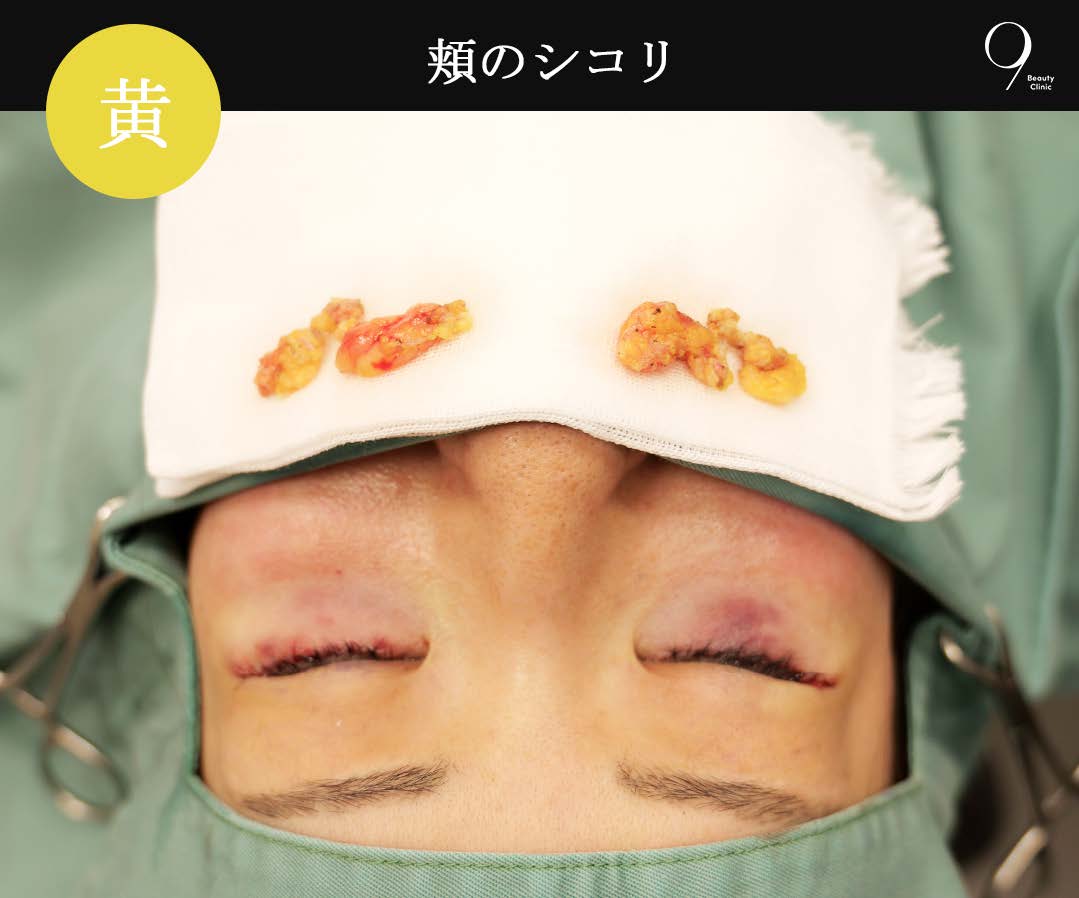 症例④:黄(SOOF/医原性 malar mound)のシコリ