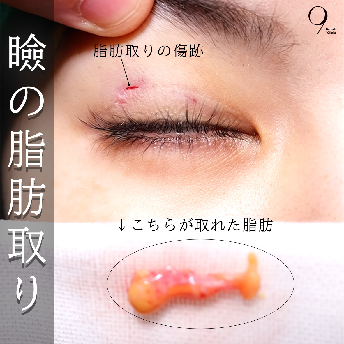 上瞼の脂肪取りをするメリット - 9 Beauty Clinic
